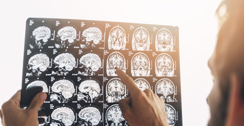 Epilepside Ani Ölüm Nedir?