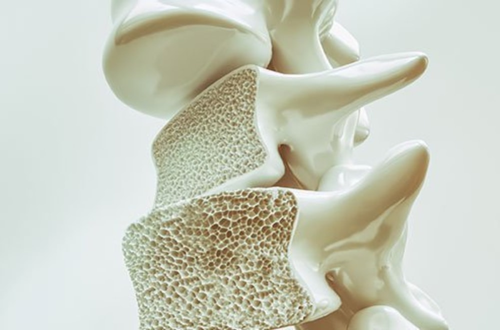Osteoporoz (Kemik Erimesi) Hakkında Bilmeniz Gereken Her Şey