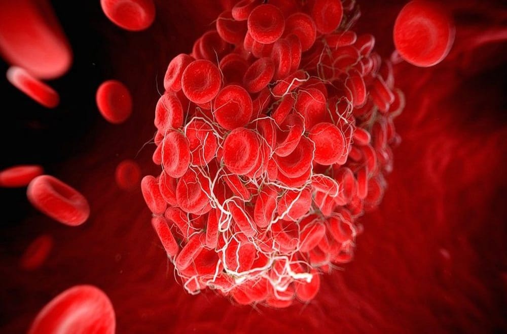 Kan Pıhtıları Hakkında Sıkça Sorulan Sorular
