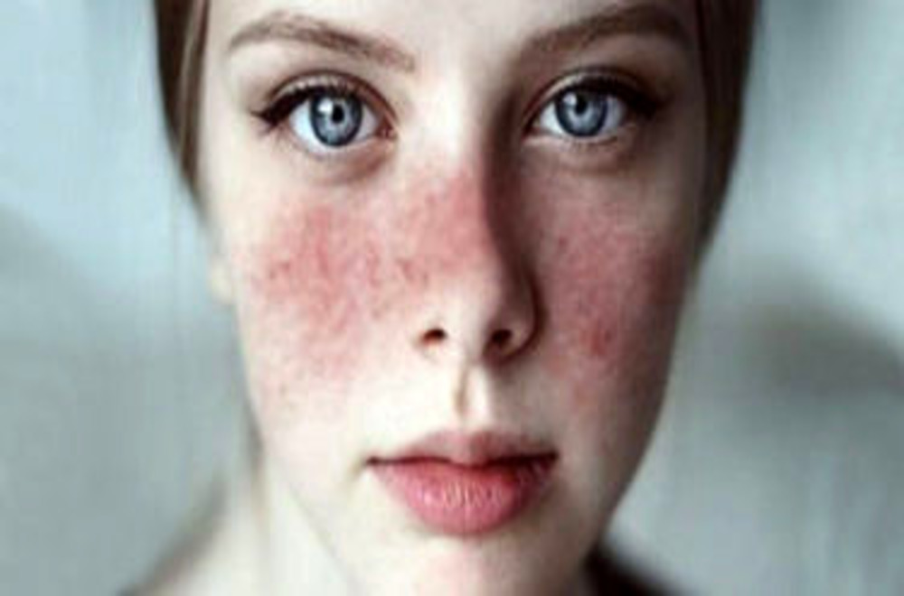 Lupus Nedir?