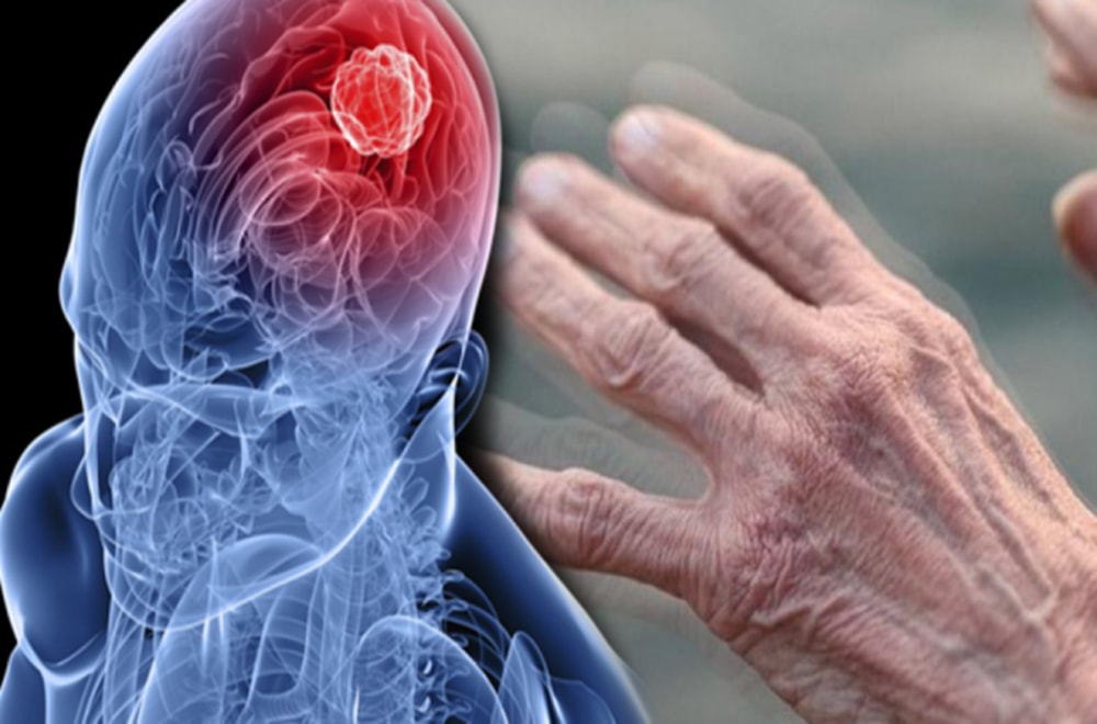 Parkinson Hastalığı Nedir?