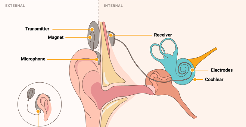 Koklear implantlar: Dil gelişimi için erken müdahale